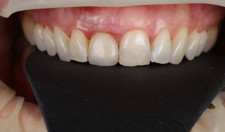 Implante Dental 3b5cde33 d3f0 4b87 9aff dbb9a59608a6