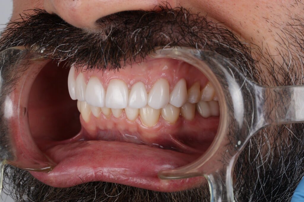 Carillas dentales img 0892
