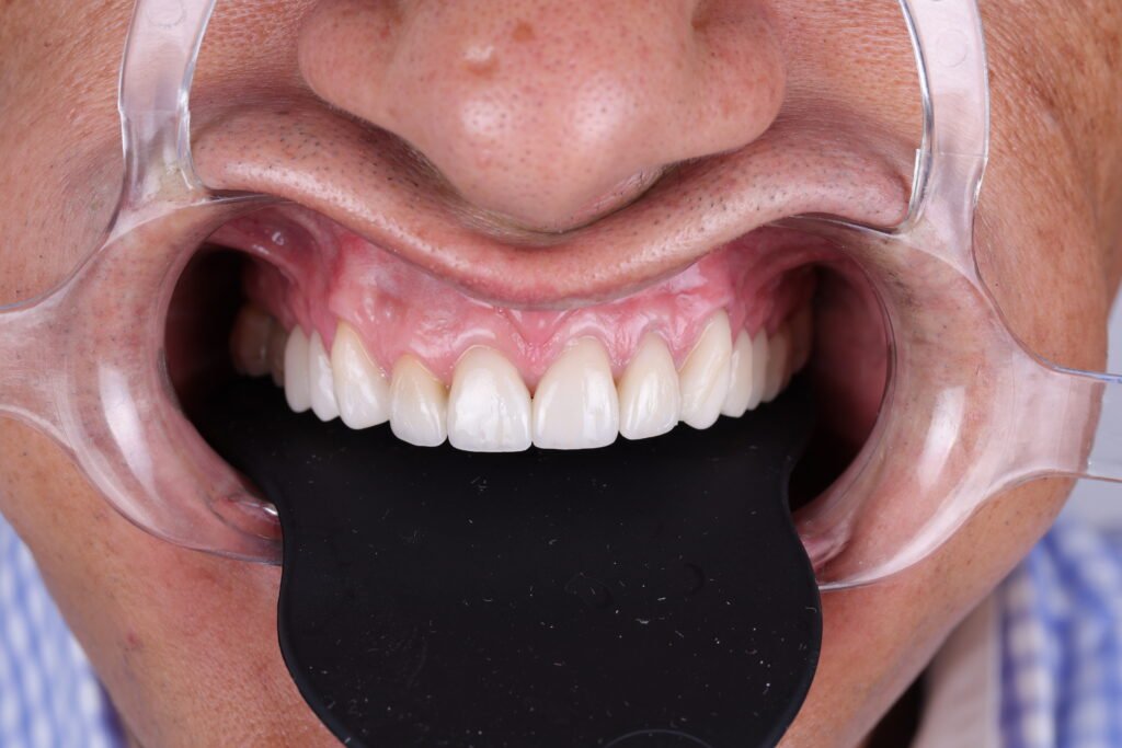 Carillas dentales img 1993