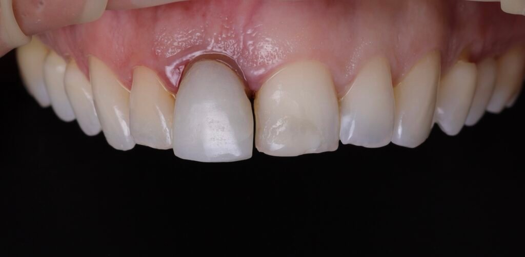 Implante Dental img 6675
