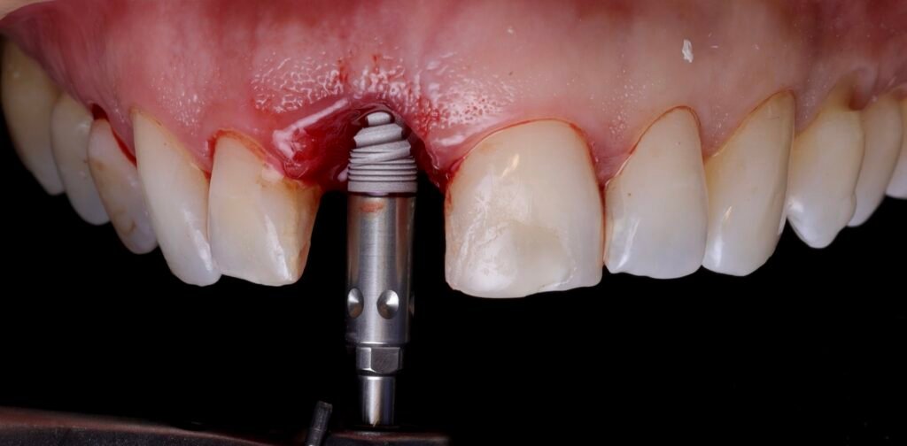 Implante Dental img 6687