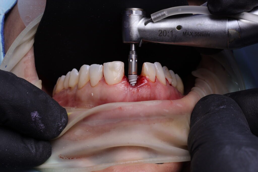 Implante Dental img 6687