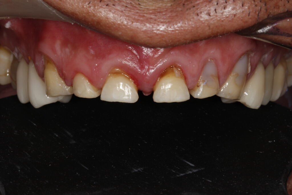 Carillas dentales mg 0540