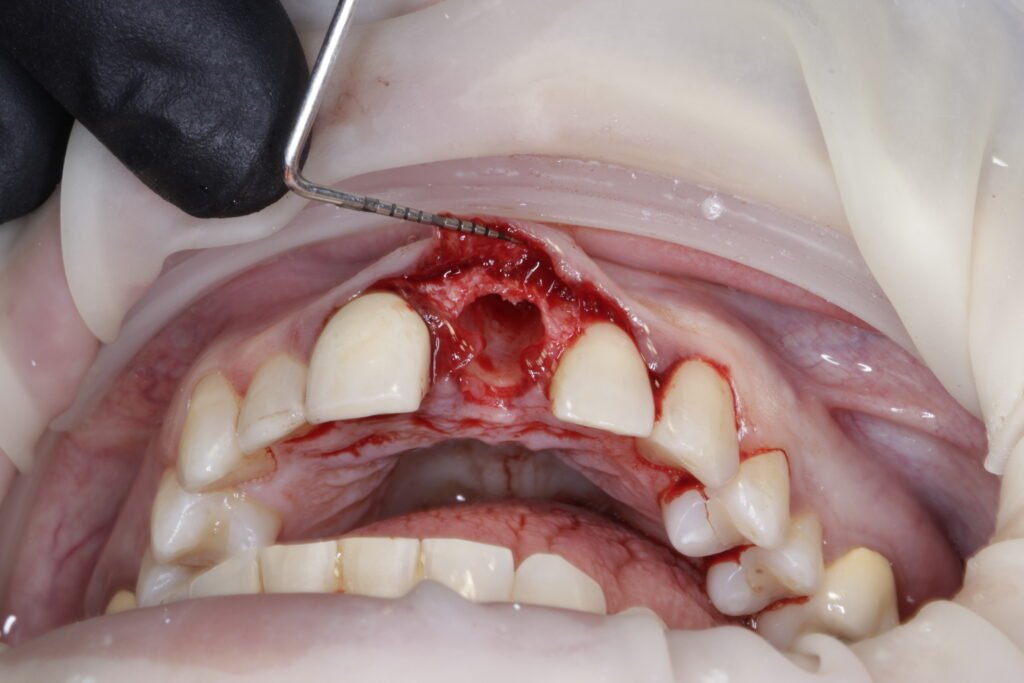 Implante Dental mg 1064