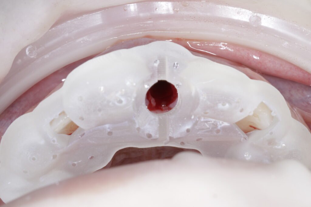 Implante Dental mg 1065