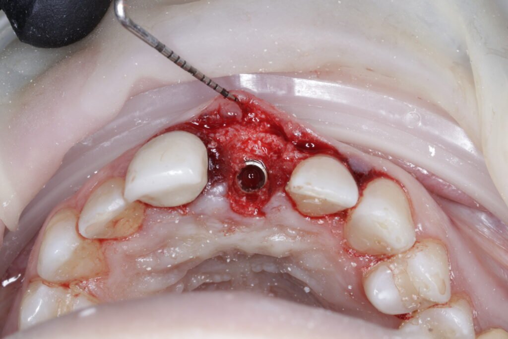 Implante Dental mg 1070