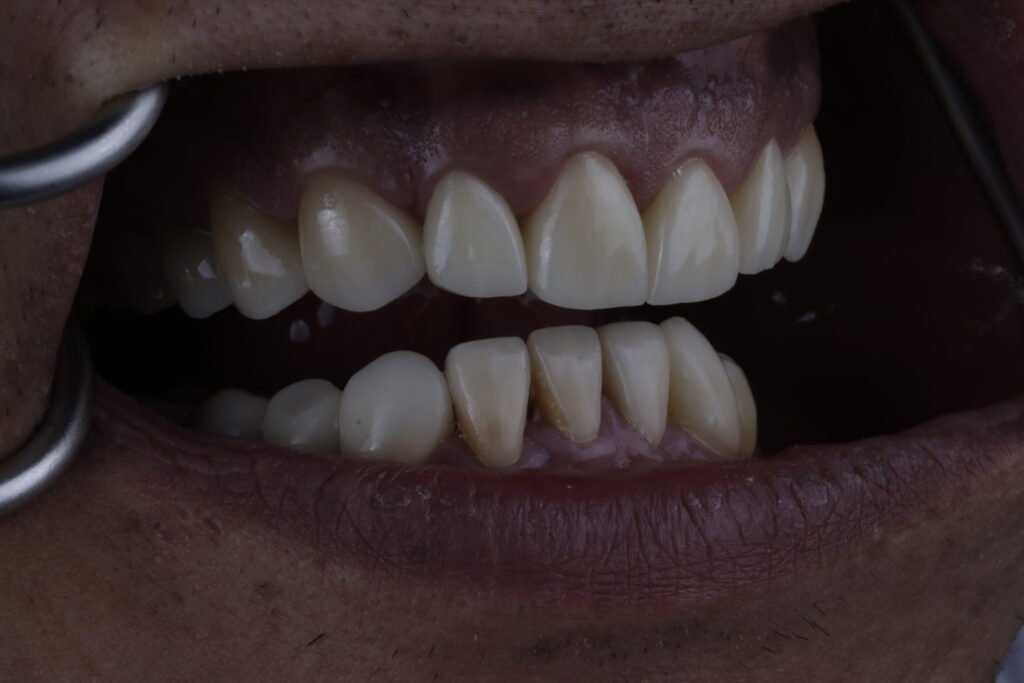 Carillas dentales mg 3489