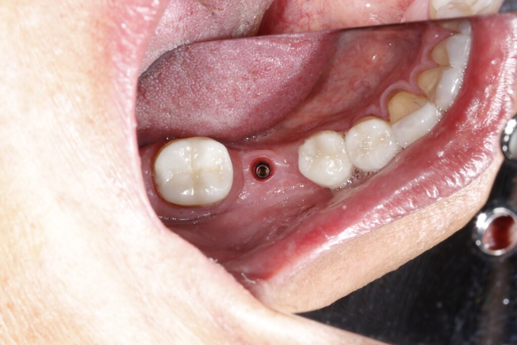 Implante Dental mg 8095
