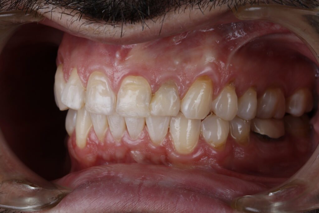 Carillas dentales mg 8282