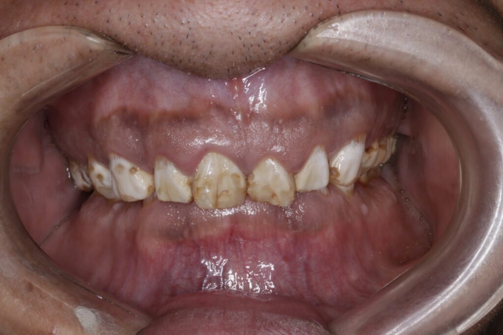 Carillas dentales mg 9044