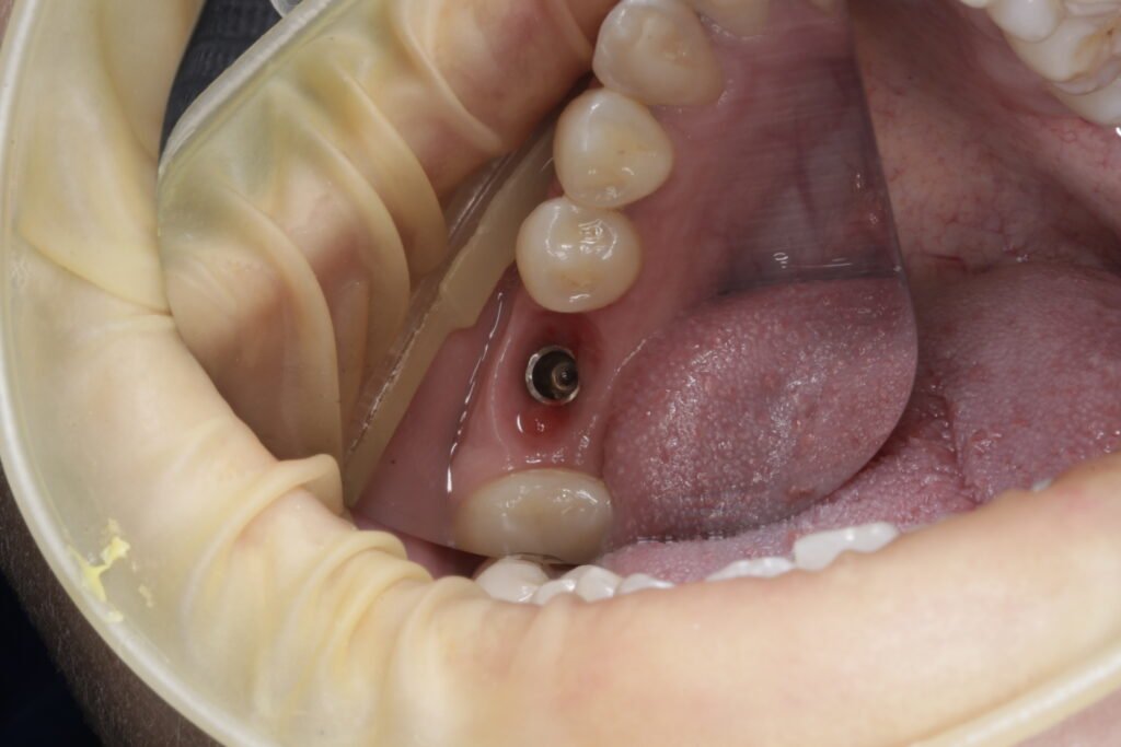 Implante Dental mg 9588